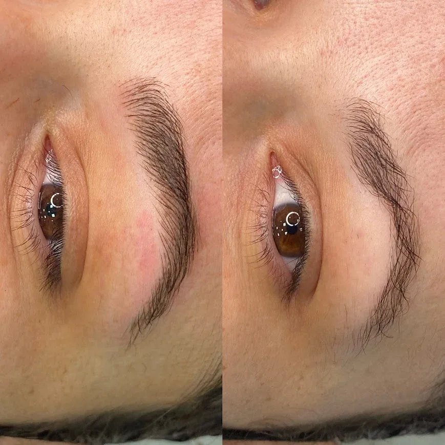 Comparação lado a lado das sobrancelhas, antes e depois do procedimento, com os olhos abertos.