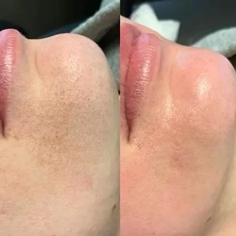 Pele do rosto antes e depois do protocolo de limpeza: poros visíveis e oleosidade dão lugar a uma pele uniforme.